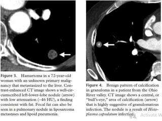 Update in evaluation of solitary pulmonary nodule | PPTX