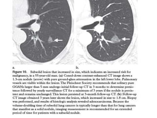 Update in evaluation of solitary pulmonary nodule | PPTX