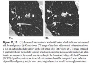 Update in evaluation of solitary pulmonary nodule | PPTX