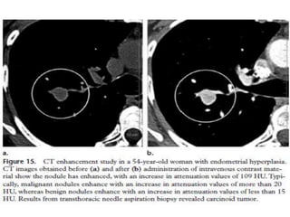 Update in evaluation of solitary pulmonary nodule | PPTX
