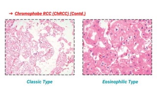 NEW UPDATES IN KIDNEY TUMOR PATHOLOGY: WHO 5th EDITION.pptx