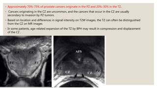 ◦ Approximately 70%-75% of prostate cancers originate in the PZ and 20%-30% in the TZ.
◦ Cancers originating in the CZ are uncommon, and the cancers that occur in the CZ are usually
secondary to invasion by PZ tumors.
◦ Based on location and differences in signal intensity on T2W images, the TZ can often be distinguished
from the CZ on MR images
◦ In some patients, age-related expansion of the TZ by BPH may result in compression and displacement
of the CZ .
 