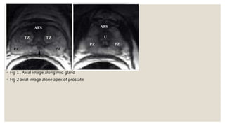 ◦ Fig 1 . Axial image along mid gland
◦ Fig 2 axial image alone apex of prostate
 