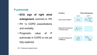 Journal Club: ECG-Based Risk Stratification in COPD - Insights from the ...