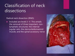 Classification of neck
dissections
Radical neck dissection (RND):
 Included are levels I– V. This entails
the removal of three important, non-
lymphatic structures: the internal
jugular vein, the sternocleidomastoid
muscle, and the spinal accessory nerve
 