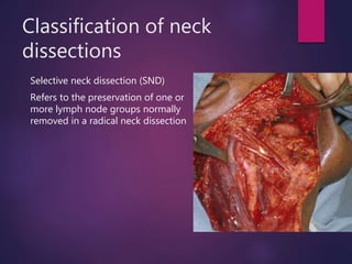 Classification of neck
dissections
Selective neck dissection (SND)
Refers to the preservation of one or
more lymph node groups normally
removed in a radical neck dissection
 
