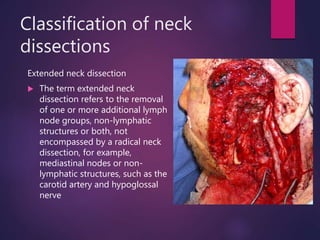 Classification of neck
dissections
Extended neck dissection
 The term extended neck
dissection refers to the removal
of one or more additional lymph
node groups, non-lymphatic
structures or both, not
encompassed by a radical neck
dissection, for example,
mediastinal nodes or non-
lymphatic structures, such as the
carotid artery and hypoglossal
nerve
 
