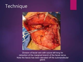 Technique
Division of facial vein with suture left long for
retraction of the marginal branch of the facial nerve.
Note the fascia has been elevated off the submandibular
gland.
 