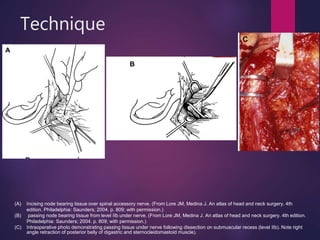Technique
(A) Incising node bearing tissue over spinal accessory nerve. (From Lore JM, Medina J. An atlas of head and neck surgery. 4th
edition. Philadelphia: Saunders; 2004. p. 809; with permission.)
(B) passing node bearing tissue from level IIb under nerve. (From Lore JM, Medina J. An atlas of head and neck surgery. 4th edition.
Philadelphia: Saunders; 2004. p. 809; with permission.)
(C) Intraoperative photo demonstrating passing tissue under nerve following dissection on submuscular recess (level IIb). Note right
angle retraction of posterior belly of digastric and sternocleidomastoid muscle).
 