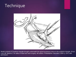 Technique
Nodal contents of posterior triangle brought underneath the spinal accessory nerve in the posterior triangle. (From
Lore JM, Medina J. An atlas of head and neck surgery. 4th edition. Philadelphia: Saunders; 2004. p. 810; with
permission
 