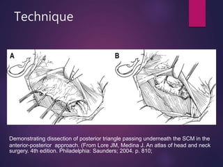 Technique
Demonstrating dissection of posterior triangle passing underneath the SCM in the
anterior-posterior approach. (From Lore JM, Medina J. An atlas of head and neck
surgery. 4th edition. Philadelphia: Saunders; 2004. p. 810;
 