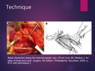 Technique
Blade dissection along the internal jugular vein. (From Lore JM, Medina J. An
atlas of head and neck surgery. 4th edition. Philadelphia: Saunders; 2004. p.
813; with permission.)
 