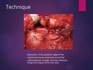 Technique
Retraction of the posterior edge of the
mylohyoid muscle anteriorly and of the
submandibular triangle contents inferiorly
brings the lingual nerve into view.
 