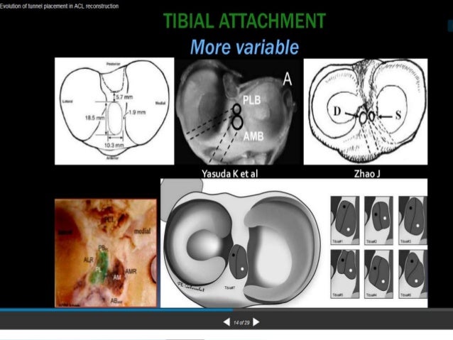 acl arthroscopic reconstruction single bundle vs double bundle