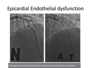 Epicardial Endothelial dysfunction
Paradoxical vasoconstriction after intracoronary acetylcholine injection
 