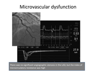 Microvascular dysfunction
There was no significant angiographic stenosis in the LAD, but the index of
microcirculatory resistance was high
 