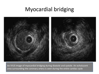 Myocardial bridging
An IVUS image of myocardial bridging during diastole and systole. An echolucent
area surrounding the coronary artery is seen during the entire cardiac cycle
 