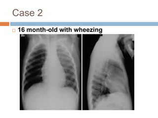 Case 2 
 16 month-old with wheezing 
 