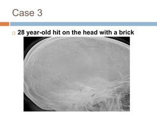 Case 3 
 28 year-old hit on the head with a brick 
 