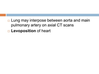 Lung may interpose between aorta and main 
pulmonary artery on axial CT scans 
 Levoposition of heart 
 