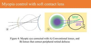 Journal club contact lens.pptx