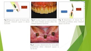 Interarch Distance Measurement Journal club interarch distance attachments Prosthodontics | PPTX