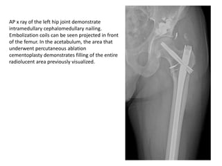Pathologic Fractures due to metastasis and its management .pptx