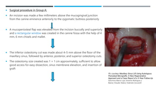  Surgical procedure in Group A:
 An incision was made a few millimeters above the mucogingival junction
from the canine eminence anteriorly to the zygomatic buttress posteriorly
 A mucoperiosteal flap was elevated from the incision buccally and superiorly
and a rectangular window was created in the canine fossa with the help of 4
mm, 6 mm chisels and mallet.
 The inferior osteotomy cut was made about 4–5 mm above the floor of the
maxillary sinus, followed by anterior, posterior, and superior osteotomy cuts.
 The osteotomy size created was 1 × 1 cm approximately, sufficient to allow
good access for easy dissection, sinus membrane elevation, and insertion of
graft
Pic courtesy: Maxillary Sinus Lift Using Autologous
Periosteal Micrografts: A New Regenerative
Approach and a Case Report of a 3-Year Follow-Up
Saturnino Marco Lupi,1Arianna Rodriguez y
Baena,1Claudia Todaro,1Gabriele Ceccarelli
 