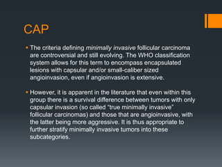 CAP
 The criteria defining minimally invasive follicular carcinoma
are controversial and still evolving. The WHO classification
system allows for this term to encompass encapsulated
lesions with capsular and/or small-caliber sized
angioinvasion, even if angioinvasion is extensive.
 However, it is apparent in the literature that even within this
group there is a survival difference between tumors with only
capsular invasion (so called “true minimally invasive”
follicular carcinomas) and those that are angioinvasive, with
the latter being more aggressive. It is thus appropriate to
further stratify minimally invasive tumors into these
subcategories.
 