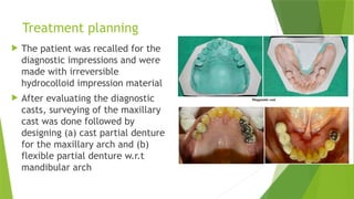 Journal club RPI RPA clasp in cast partial dentures.pptx
