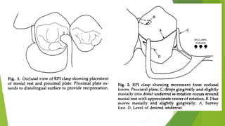 Journal club RPI RPA clasp in cast partial dentures.pptx