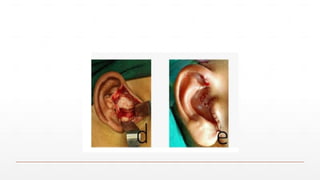 Inviscision vs Endaural Incision: Advances in TMJ Surgical Techniques ...