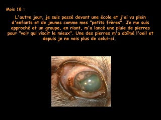 Mois 18 :
L'autre jour, je suis passé devant une école et j'ai vu plein
d'enfants et de jeunes comme mes "petits frères". Je me suis
approché et un groupe, en riant, m'a lancé une pluie de pierres
pour "voir qui visait le mieux". Une des pierres m'a abîmé l'oeil et
depuis je ne vois plus de celui-ci. 
 
