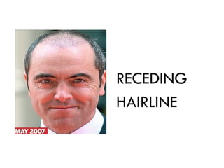 RECEDING
HAIRLINE
 