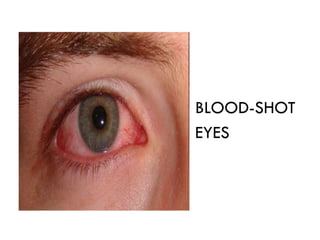 BLOOD-SHOT
EYES
 