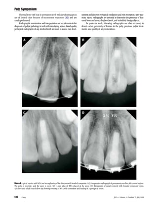 Rarefaction Radiograph Journal of endodontics | PDF