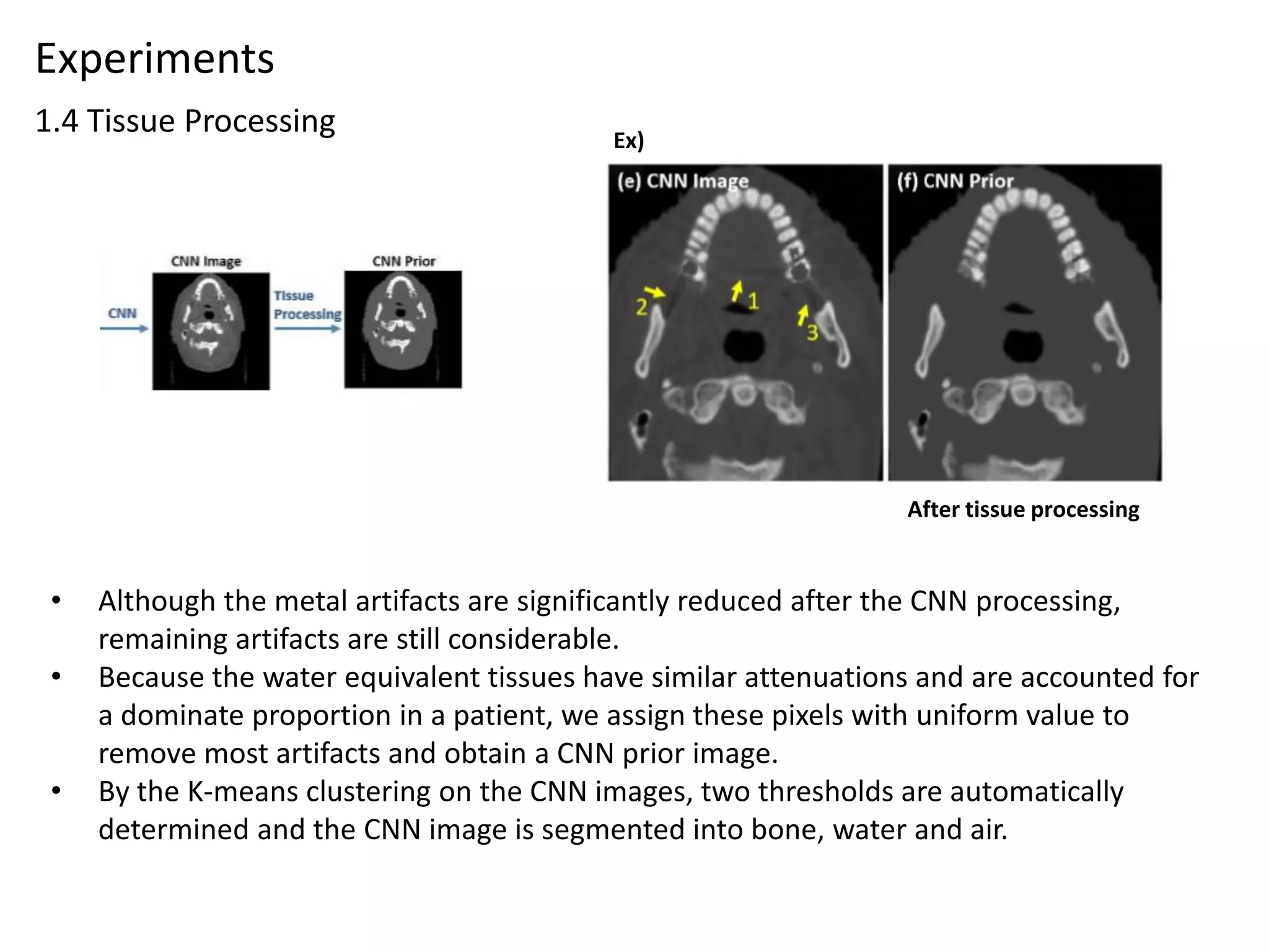 Convolutional neural network based metal artifact reduction in x ray ...