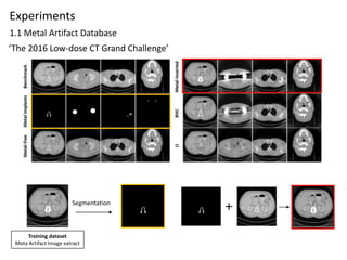 Convolutional neural network based metal artifact reduction in x ray ...