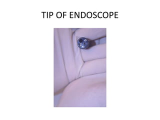 TIP OF ENDOSCOPE
 