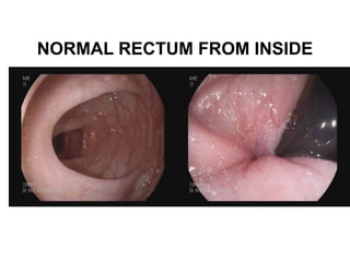 NORMAL RECTUM FROM INSIDE
 