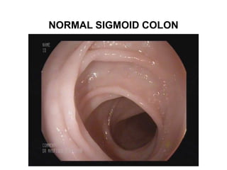 NORMAL SIGMOID COLON
 