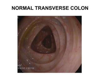 NORMAL TRANSVERSE COLON
 