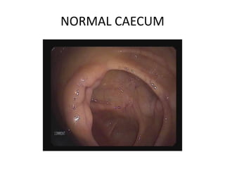 NORMAL CAECUM
 