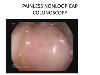 PAINLESS NONLOOP CAP
COLONOSCOPY
 