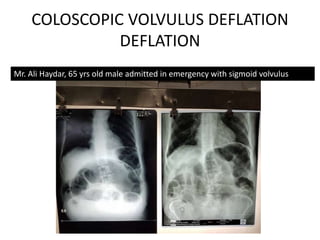 COLOSCOPIC VOLVULUS DEFLATION
DEFLATION
Mr. Ali Haydar, 65 yrs old male admitted in emergency with sigmoid volvulus
 