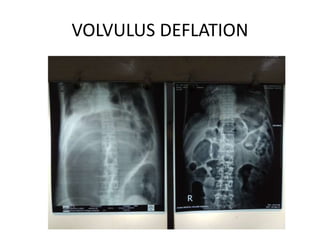 VOLVULUS DEFLATION
 