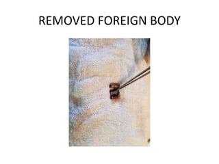 REMOVED FOREIGN BODY
 