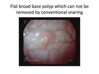 Flat broad base polyp which can not be
removed by conventional snaring
 