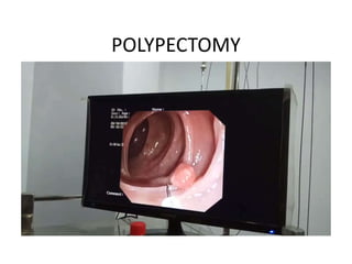 POLYPECTOMY
 