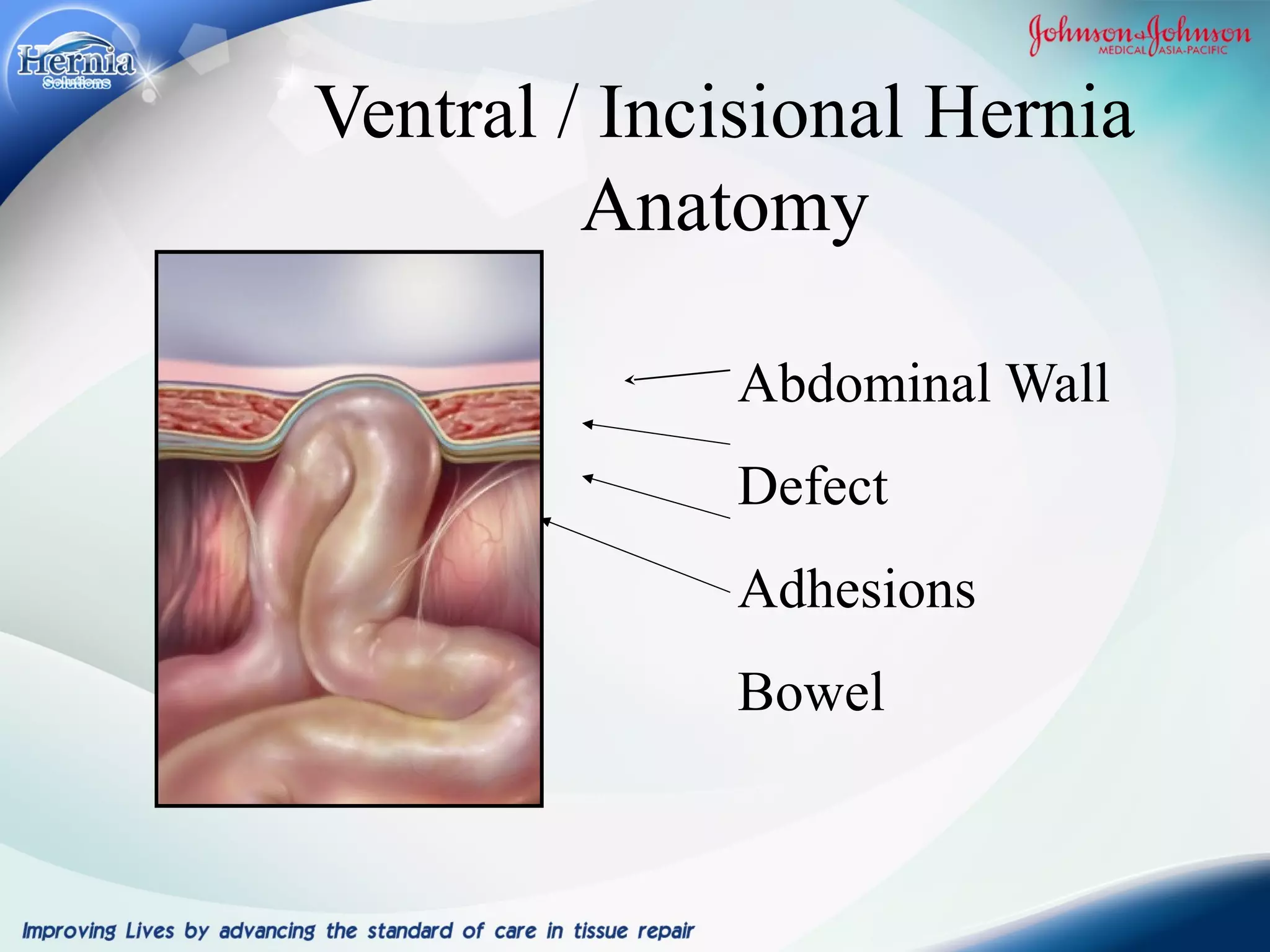 MY JOURNEY WITH HERNIA SURGERY PPT my-journey-with-hernia-surgery-ppt